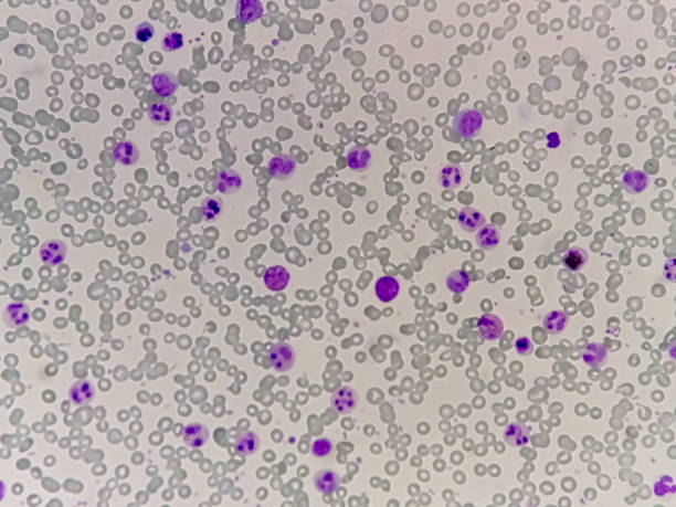 istock Chronic myelocytic leukemia (CML)  with chronic phase. Hematology. 40x 1357444448