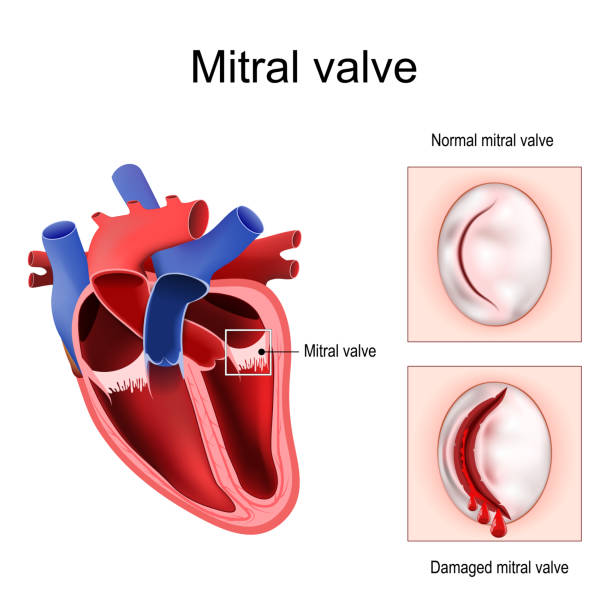 Heart anatomy.  Mitral valve Heart anatomy. Close-up of Normal Mitral valve and Damaged mitral valve. Cross section of human heart. detailed diagram. Vector poster pericarditis stock illustrations