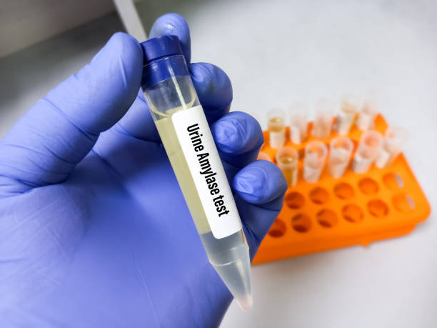 istock Urine sample for urinary amylase test, Urinalysis. 1357574907