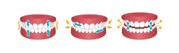 ilustrações, clipart, desenhos animados e ícones de tipos de bruxismo (ranger de dentes) ilustração vetorial - grinding