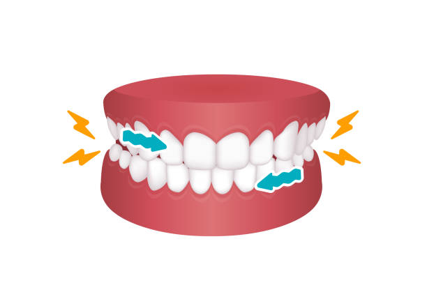 Bruxism vector illustration | grinding teeth Bruxism vector illustration | grinding teeth clenching teeth stock illustrations