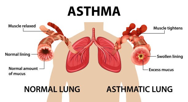 ilustrações, clipart, desenhos animados e ícones de diagrama de asma brônquica com pulmão normal e pulmão asmático - árvore brônquica