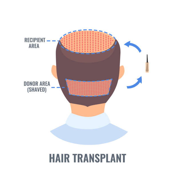 ilustrações, clipart, desenhos animados e ícones de transplante capilar masculino com método fue - alopecia homem