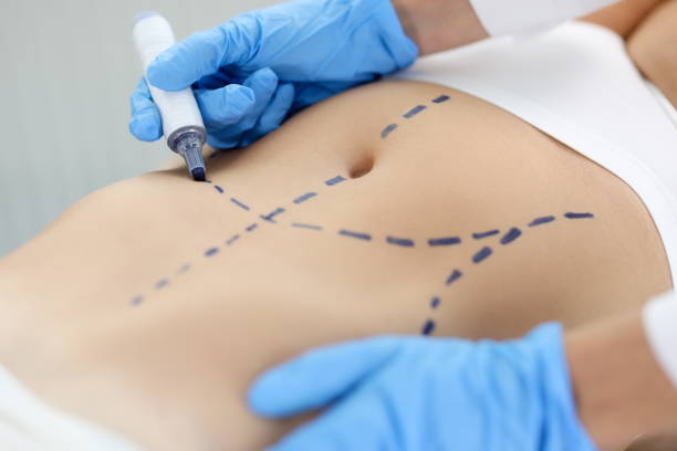 doctor drawing preoperative marking on patient abdomen closeup - overweight tummy tuck abdomen body imagens e fotografias de stock