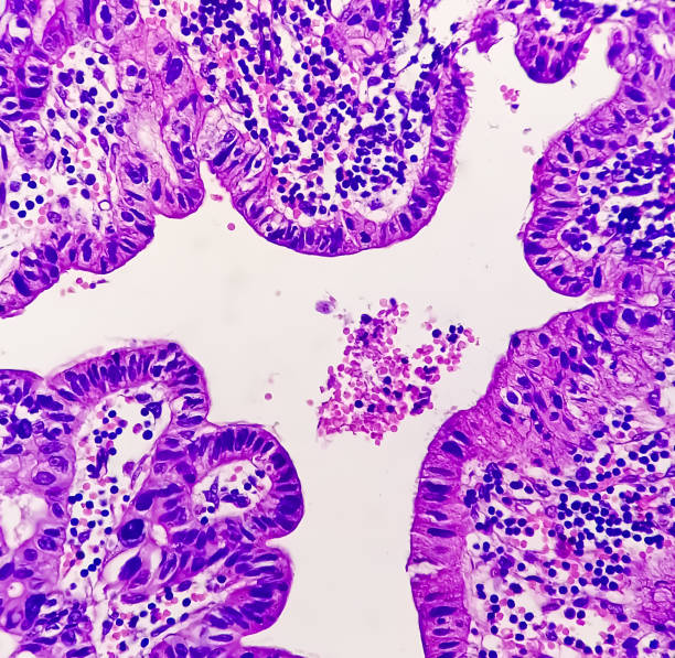 sensibilisation au cancer de la prostate : photomicrographie (image microscopique) de la biopsie centrale de la prostate montrant un adénocarcinome. - prostate gland photos et images de collection