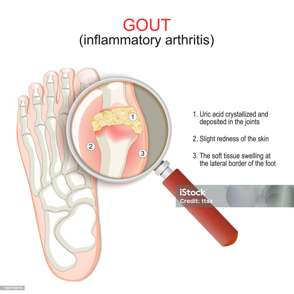 Guta Hack Gout Closeup Of Joint With Inflammatory Arthritis Stock Illustration ...