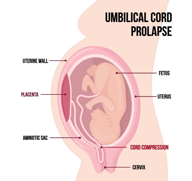 ilustrações de stock, clip art, desenhos animados e ícones de prolapsed umbilical cord - placenta baby childbirth newborn