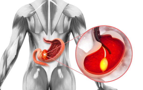 stomach cancer, stomach endoscopy. 3d illustration - cancro gástrico imagens e fotografias de stock