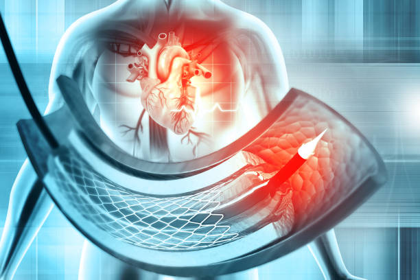 stent y catéter para implantación en vasos sanguíneos. ilustración 3d - angioplasty fotografías e imágenes de stock