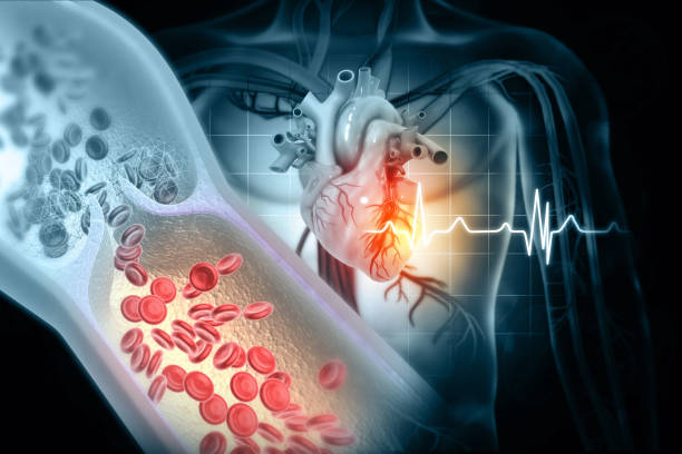 Cholesterol blocked artery with human heart. 3d illustration stock photo