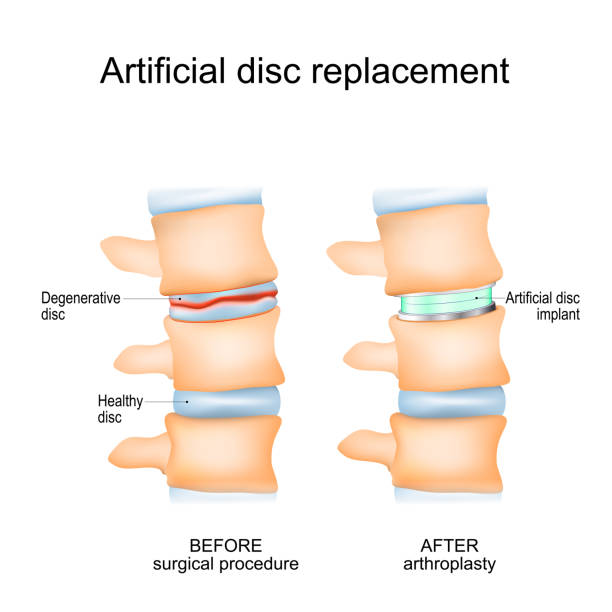 Intervertebral disc arthroplasty Intervertebral disc arthroplasty. Close-up of a human spinal column before Surgical procedure and after Arthroplasty. Degenerative Disc and Artificial disc replacement. Vector poster spinal surgery recovery stock illustrations