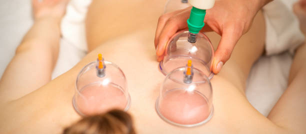 침술 여자 치료사는 여성 환자의 뒷면에 컵을 배치. - acupuncture cupping 뉴스 사진 이미지