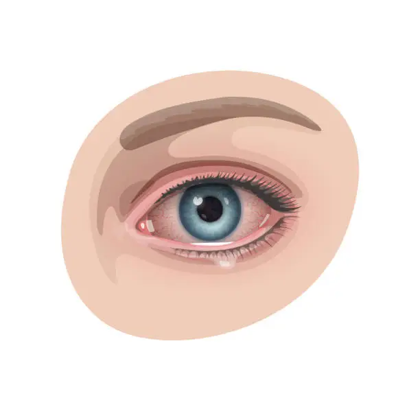 Vector illustration of Red bloodshot human eye with multiple vessels and tears