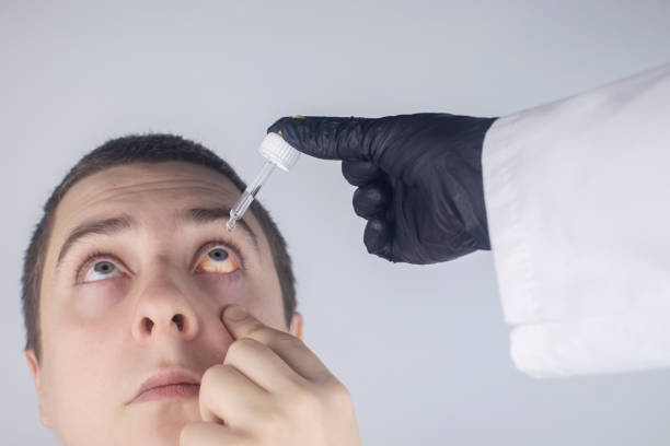 close-up de colírios. um homem na consulta médica, que pinga gotas nos olhos do paciente. conjuntivite de tratamento conceitual, fadiga ocular, glaucoma. infecções virais ou bacterianas - lubrication infection - fotografias e filmes do acervo