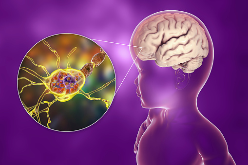 Tay-Sachs disease, a lysosomal storage genetic disorder, 3D illustration. A child with macrocephaly, and close-up view of swollen neurons with lamellar inclusions due to accumulation of gangliosides