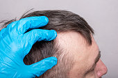 menschliche-glatze-oder-haarausfall-nach-coronavirus-ein-arzt-in-blauen-medizinischen.jpg?b=1&s=170x170&k=20&c=8BN0caFoSCYZeOeGyfAsGCfmqKR-DlfS__wNZlFV5kU=