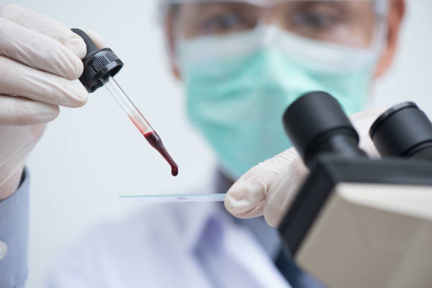 Blood exam Doctor or lab technician dripping red blood on slide glass for malaria test, blood group test, complete blood count (CBC) with microscope in hospital laboratory. close up malaria blood sample stock pictures, royalty-free photos & images