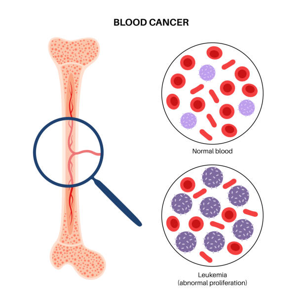 illustrations, cliparts, dessins animés et icônes de leucémie cancéreuse - blood cell illustrations