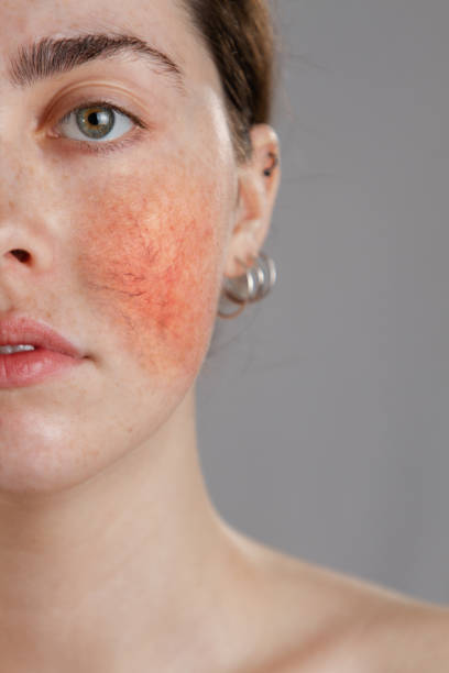 cosmetologia e rosacea. retrato de metade do rosto de uma jovem com rosacea em suas bochechas - rosácea irritação cutânea - fotografias e filmes do acervo