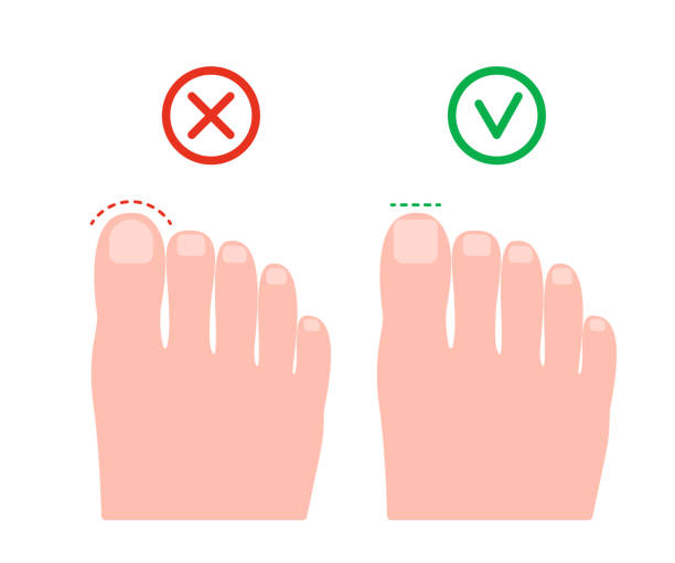 Cut nail on leg wrong and right, health pedicure. Circle and straight cutting nail. Prevention of ingrown nails. Vector illustration Cut nail on leg wrong and right, health pedicure. Circle and straight cutting nail. Prevention of ingrown nails. Vector toenail stock illustrations