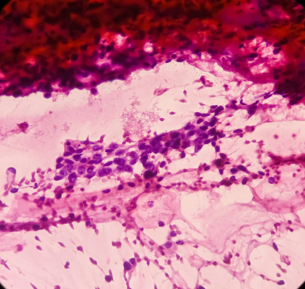 istock Pancreatic mass(CT Guided FNA): Positive malignant cell, adenocarcinoma, atypical epithelial cells 1358713507