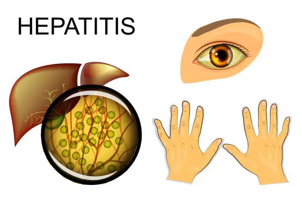 Vector illustration of Hepatitis, liver