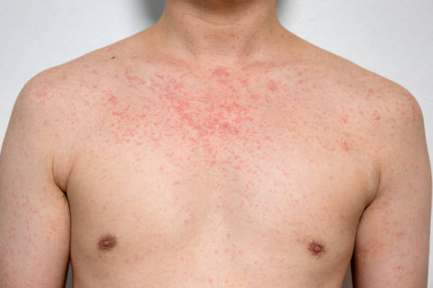 Dermatitis rash viral disease with immunodeficiency on body of young adult asian, scratch with itch Dermatitis rash viral disease with immunodeficiency on body of young adult asian, scratch with itch, Measles Virus, Viral Exanthem measles stock pictures, royalty-free photos & images
