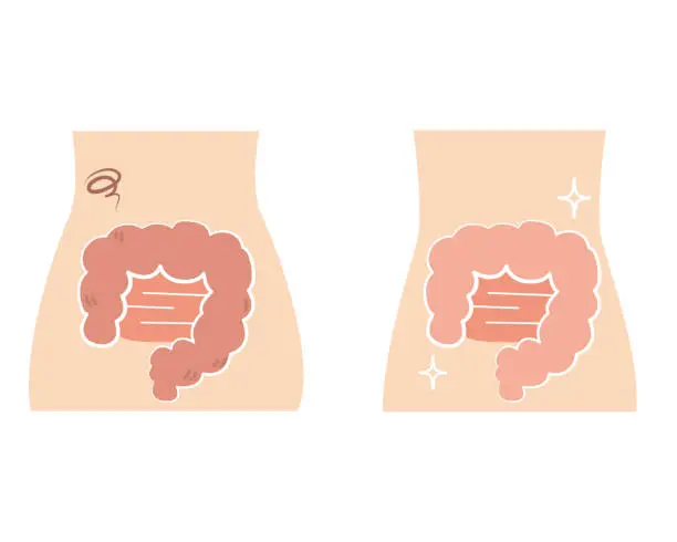 Vector illustration of A set of moderately unhealthy intestines and moderately healthy intestines