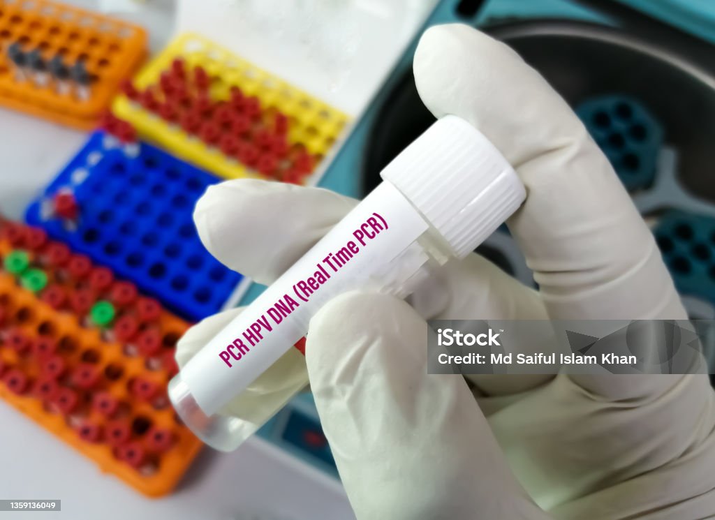 Cancer Test Containers Scientist Holding Sample Container Cervical Fluid Sample For Pcr Hpv ...