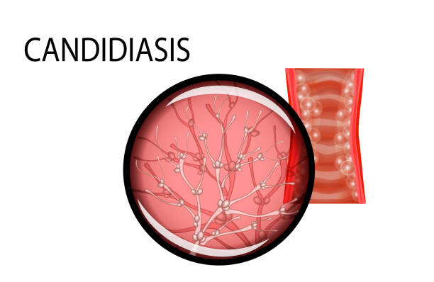 ilustraciones, imágenes clip art, dibujos animados e iconos de stock de mucosa vaginal de la paciente de la candidiasis - thrush