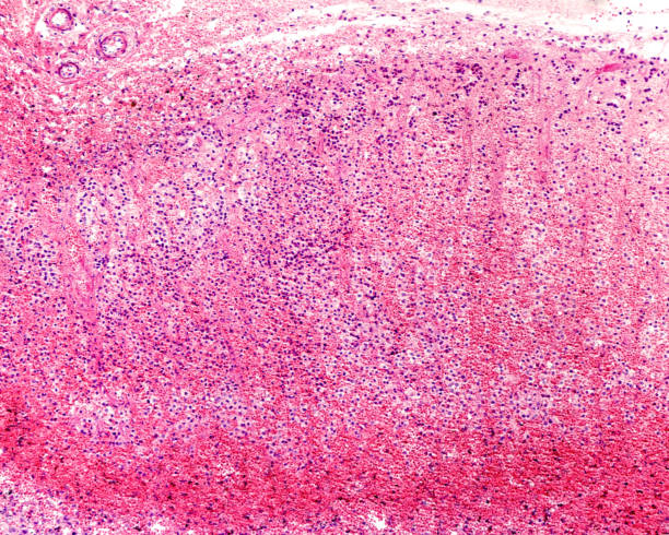 istock Human adrenal cortex. Waterhouse-Friderichsen syndrome 1359209914