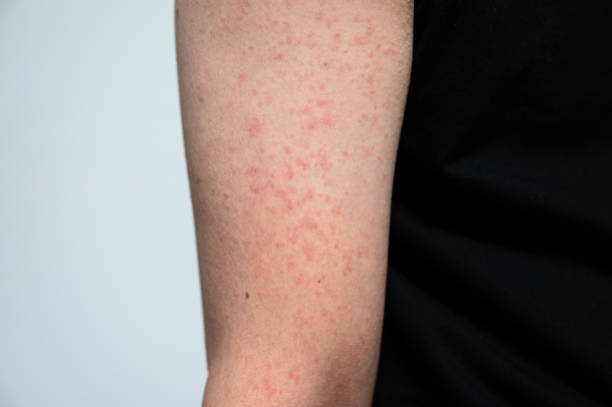 dermatite rash malattia virale con immunodeficienza sul braccio di giovane adulto asiatico, graffio con prurito - immunodeficiency foto e immagini stock