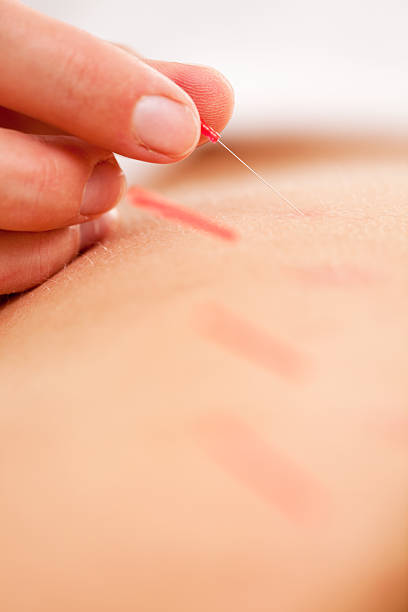 istock Qi - Acupuncture Neddle Rotation and Stimulation 135938266