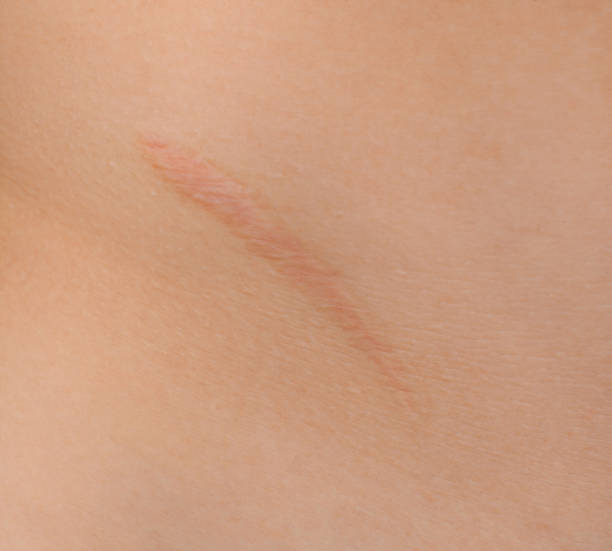 Healed scar after Appendicitis surgery. stock photo