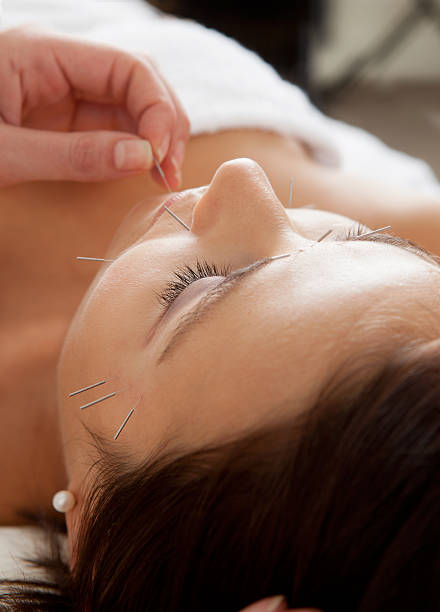istock Facial Acupuncture Beauty Treatment 135940961