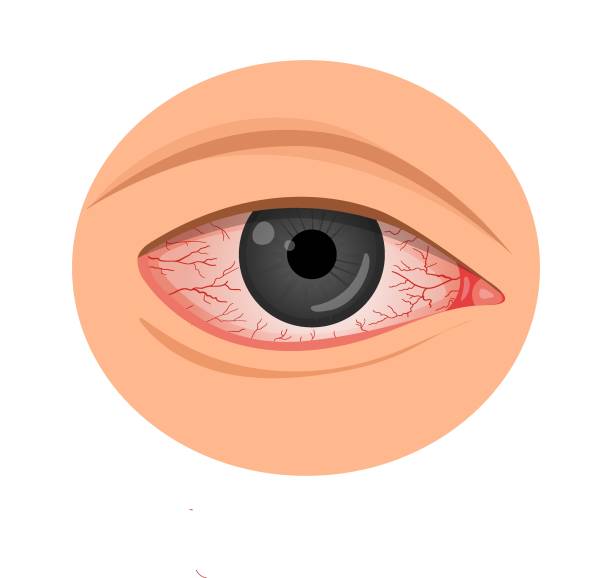 Ojos Irritados Vectores Libres de Derechos - iStock Ojos Irritados Vectores Libres de Derechos - iStock