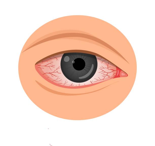 眼刺激。コニュクテビティス、角膜炎、アレルギー、子宮炎。 - sore eyes点のイラスト素材／クリップアート素材／マンガ素材／アイコン素材