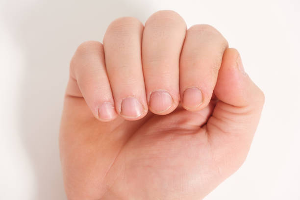 istock Unkempt male nails with a regrown cuticle on a white background 1359481950
