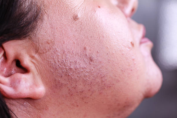 istock Skin face after removing hair 1359484370
