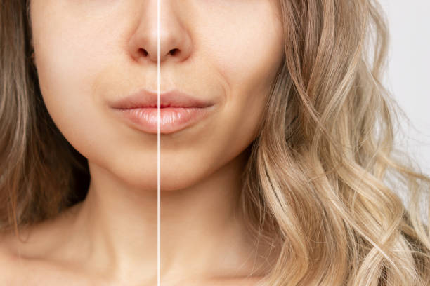 una mujer joven antes y después de la cirugía plástica eliminación de la almohadilla de grasa bucal resultado de la cirugía estética - mejilla fotografías e imágenes de stock