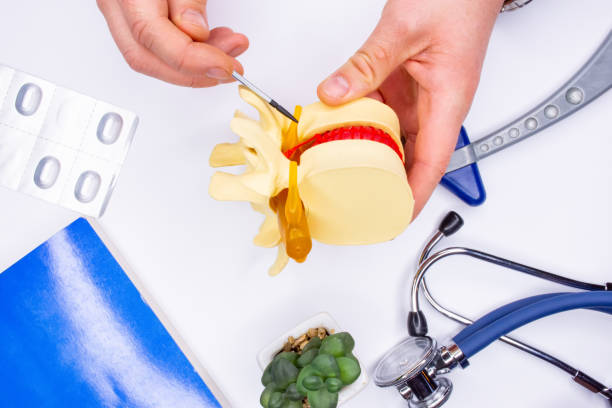 Pathology of ganglion of the spinal cord as cause of back pain. A neurologist or traumatologist shows patient during consultation of the spinal cord root as the cause of the disease and pain syndrome Pathology of ganglion of the spinal cord as cause of back pain. A neurologist or traumatologist shows patient during consultation of the spinal cord root as the cause of the disease and pain syndrome neuralgia stock pictures, royalty-free photos & images