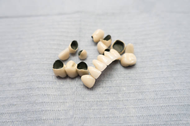 dental ceramic metal bridges are on the table