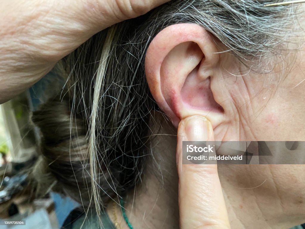 귀에 여드름 귀 부분에 대한 스톡 사진 및 기타 이미지 - 귀 부분, 뾰루지, 몸 가꾸기 - iStock 귀에 여드름 귀 부분에 대한 스톡 사진 및 기타 이미지 - 귀 부분, 뾰루지, 몸 가꾸기 - Istock
