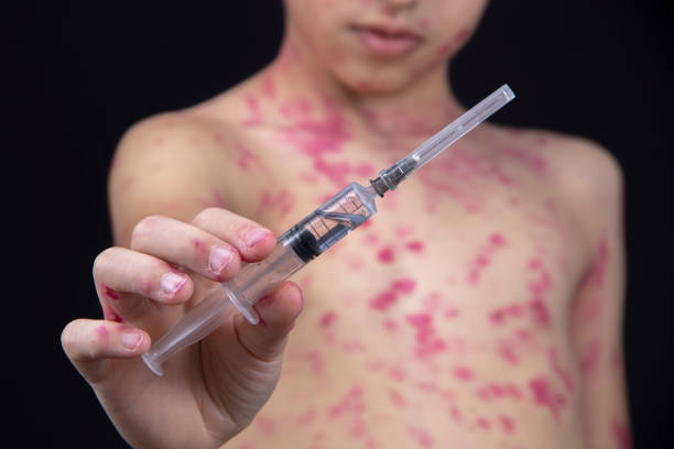 A boy is holding a syringe with a vaccine for the virus in his hand. A boy is holding a syringe with a vaccine for the virus in his hand. Skin rash on the child in the background. Chickenpox virus. Treatment concept tetanus photos stock pictures, royalty-free photos & images