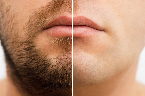 close up photo of a man's face before and after shaving. a young man with a beard. comparison of a man's face with a beard and without a beard. use of aftershave cream - kaal geschoren hoofd stockfoto's en -beelden