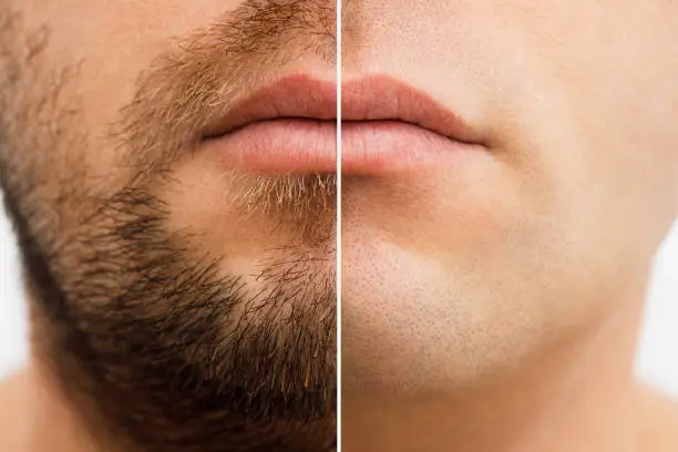 Photo of Close up photo of a man's face before and after shaving. a young man with a beard. Comparison of a man's face with a beard and without a beard. use of aftershave cream