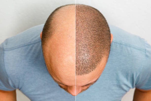 la tête d’un homme chauve avant et après la chirurgie de greffe de cheveux. un homme qui perd ses cheveux est devenu hirsute. une affiche publicitaire pour une clinique de greffe de cheveux. traitement de la calvitie - grafted photos et images de collection