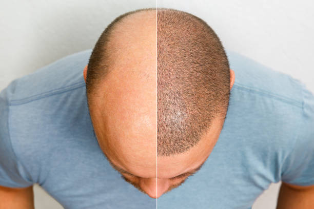 970+ Hair Transplant Stock Photos, Pictures & Royalty-Free Images - iStock  | Hair restoration, Hair loss, Hair implant