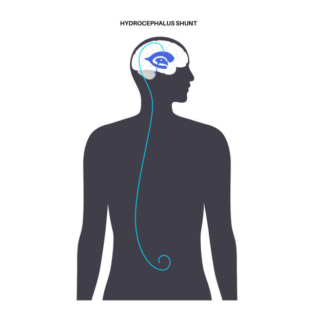 illustrations, cliparts, dessins animés et icônes de concept de shunt d’hydrocéphalie - choroid