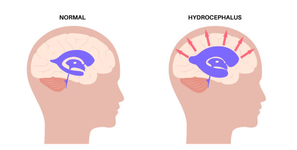 illustrations, cliparts, dessins animés et icônes de système ventriculaire - choroid